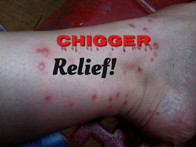 How do you treat chigger bites?